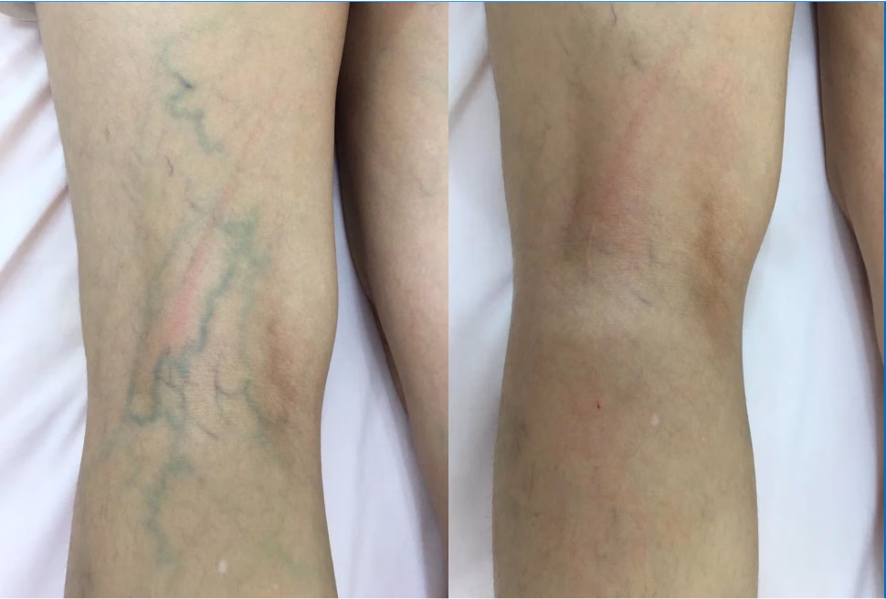 Gối Kê Tam Giác Yuminami 7 Người bị suy giãn tĩnh mạch